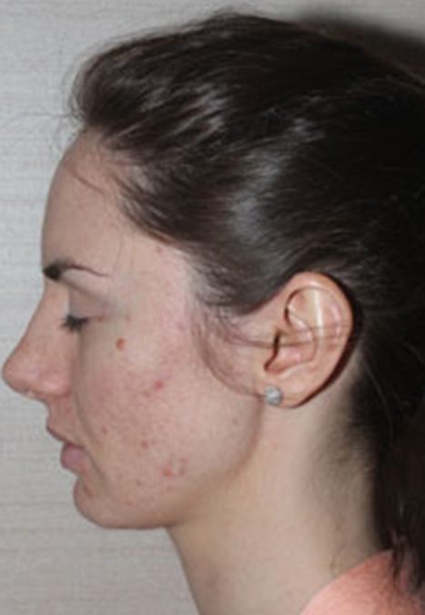 Female patient after reconstructive septorhinoplasty