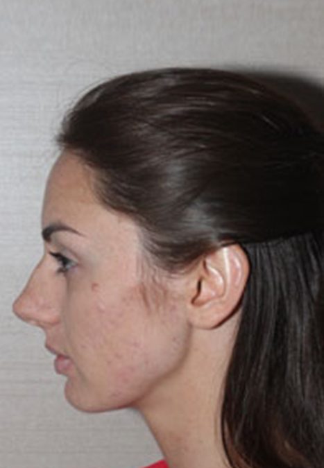 Female patient before reconstructive septorhinoplasty