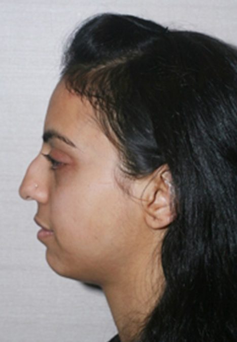Female patient before reconstructive septorhinoplasty