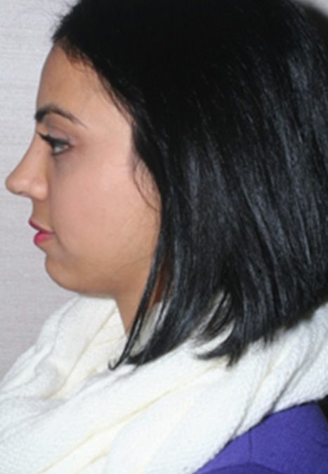 Female patient after reconstructive septorhinoplasty