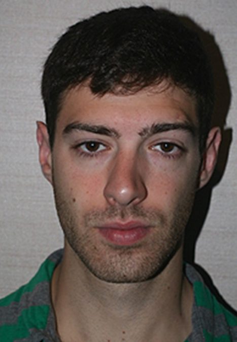 Male patient before reconstructive septorhinoplasty