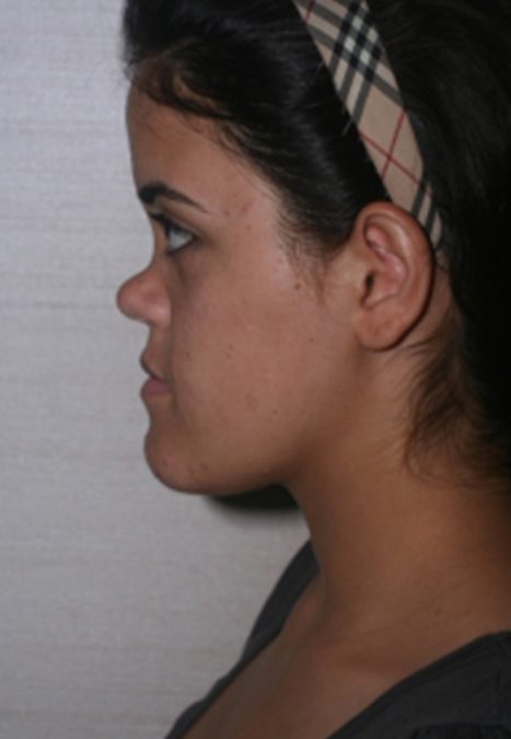 Female patient before reconstructive septorhinoplasty