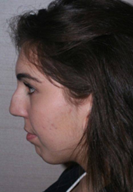 Female patient before reconstructive septorhinoplasty