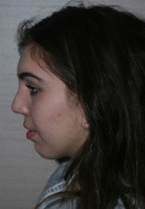 Female patient after reconstructive septorhinoplasty