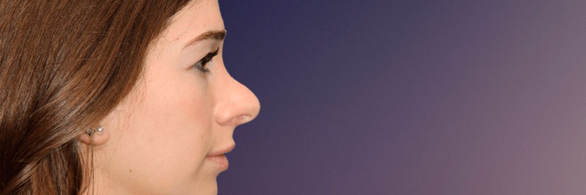 Before revision rhinoplasty