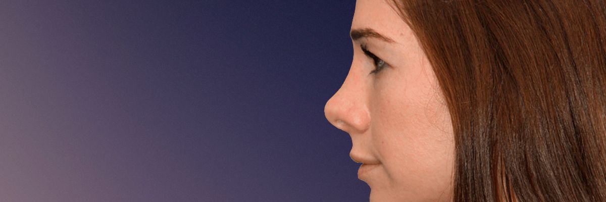 After revision rhinoplasty