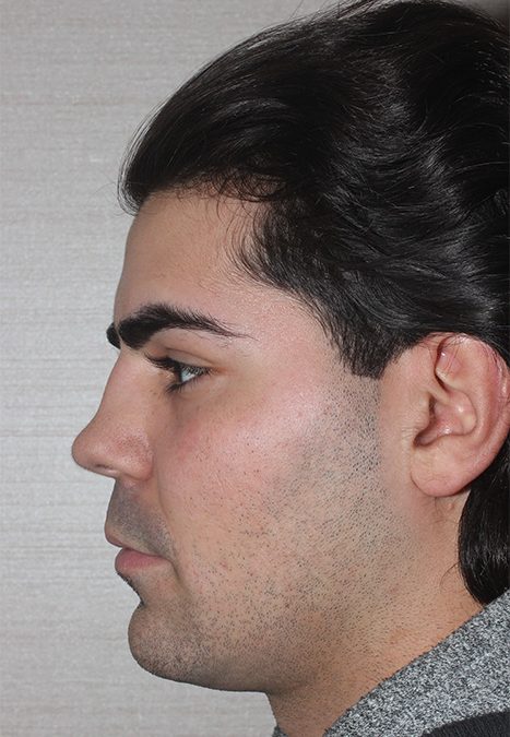 Male patient before rhinoplasty reconstruction
