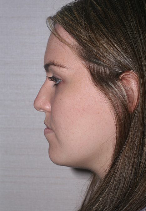 Female patient after rhinoplasty reconstruction