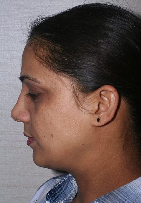 Female patient before rhinoplasty reconstruction