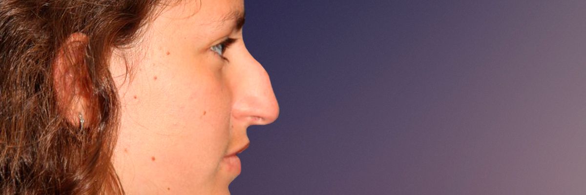 Before rhinoplasty surgery