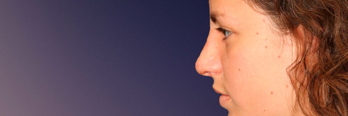 After rhinoplasty surgery