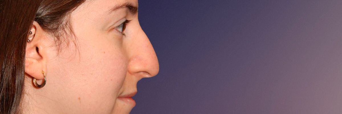 Rhinoplasty before and after comparison.