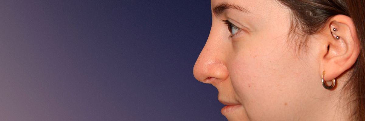 Rhinoplasty surgery comparison