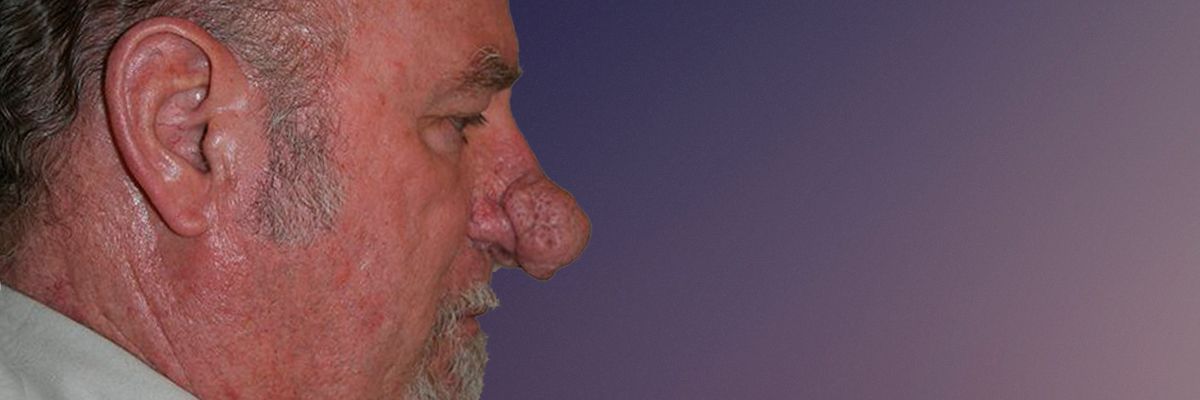 Mala patient before rhinophyma treatment in Toronto
