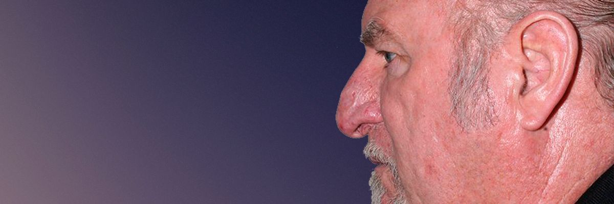 Mala patient after rhinophyma treatment in Toronto