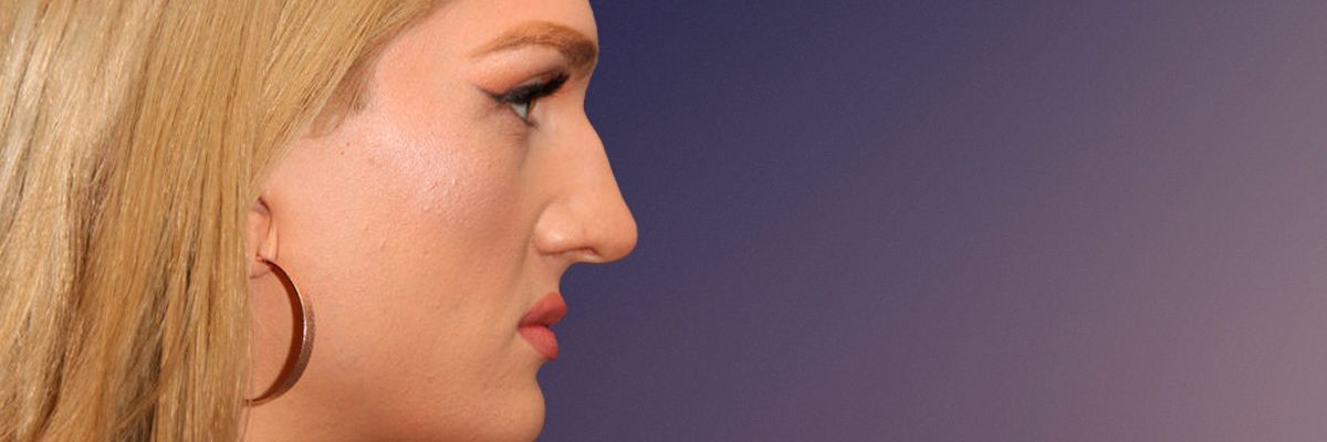 Before transgender rhinoplasty