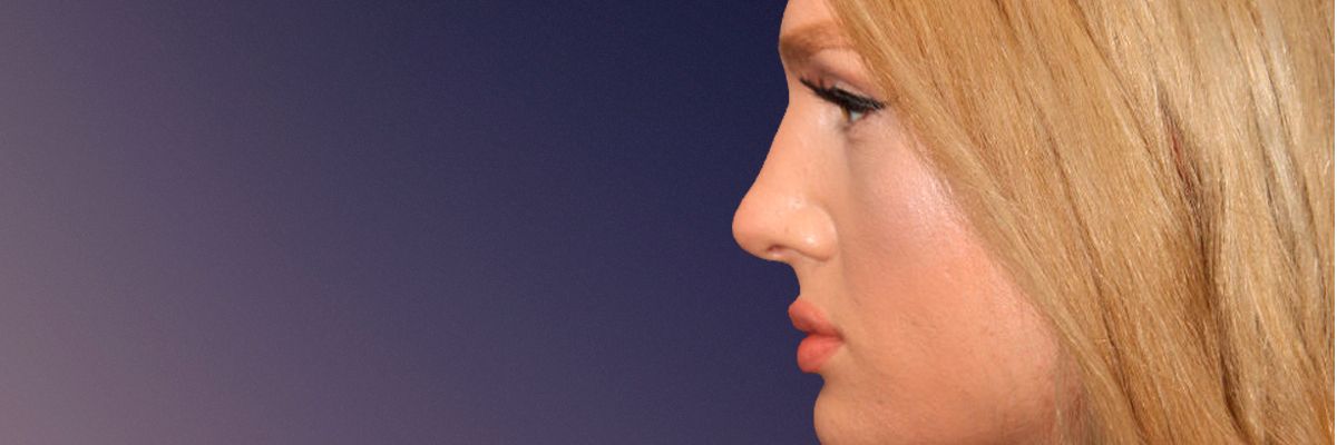 After transgender rhinoplasty