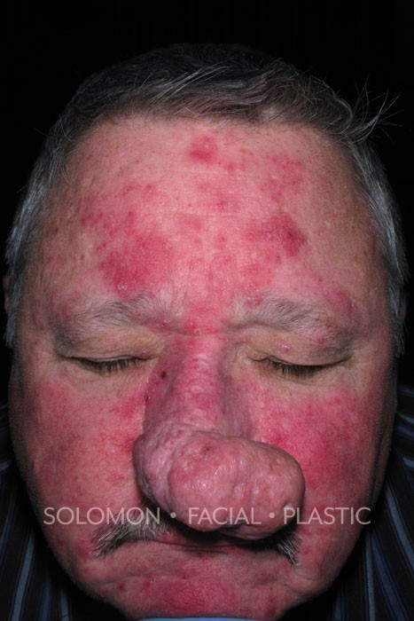 Male patient before Rhinophyma