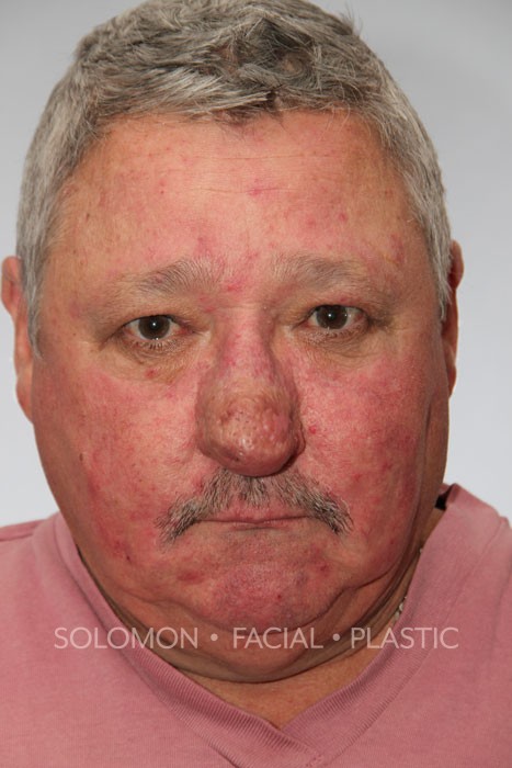 Male patient after Rhinophyma