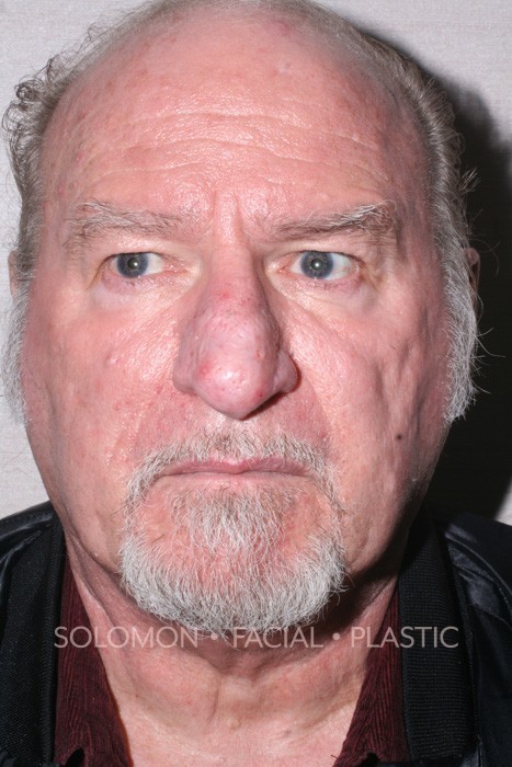 Male patient after Rhinophyma