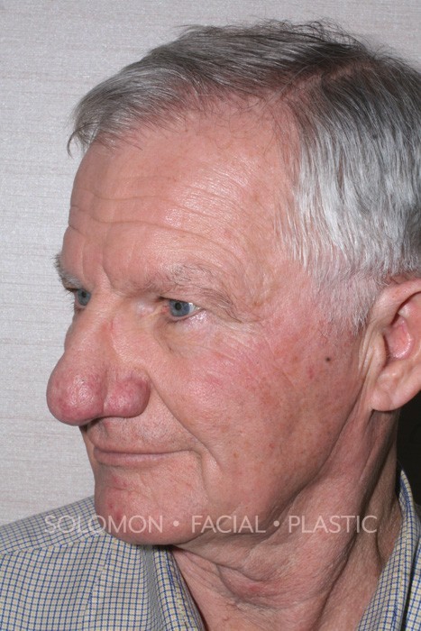Male patient before Rhinophyma