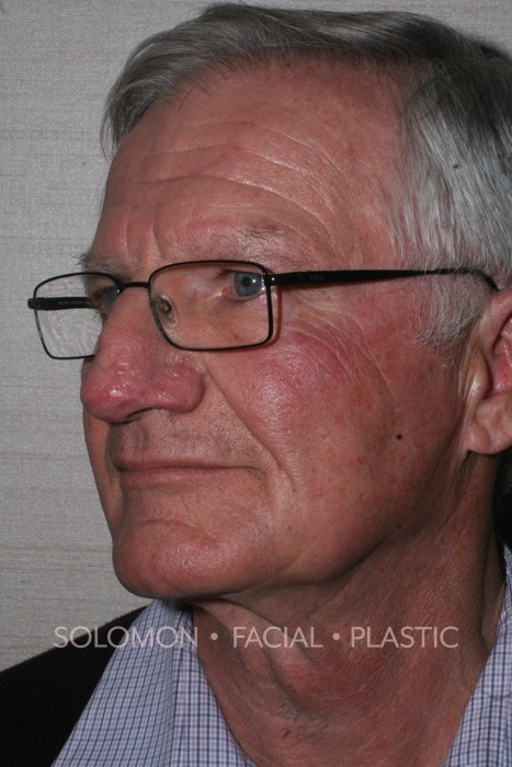 Male patient after Rhinophyma