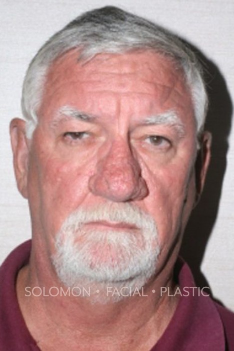 Male patient before Rhinophyma