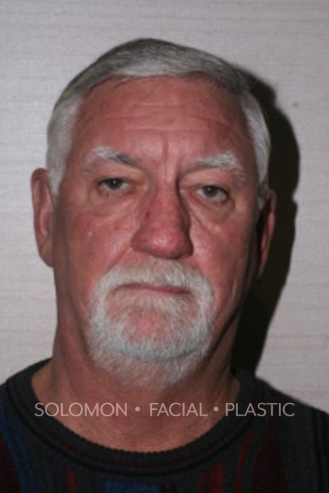 Male patient after Rhinophyma