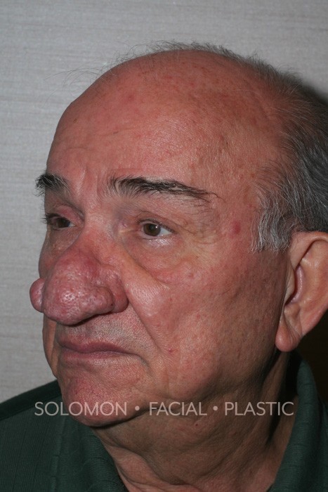 Male patient before Rhinophyma