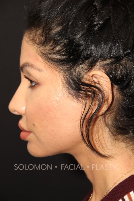 Female patient before primary rhinoplasty