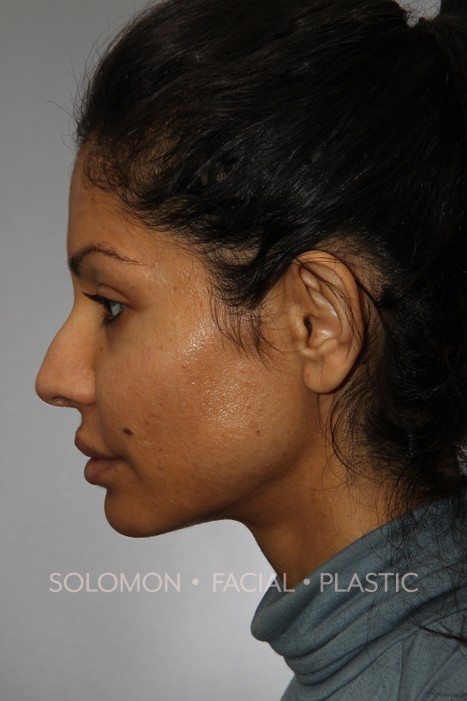 Female patient after primary rhinoplasty