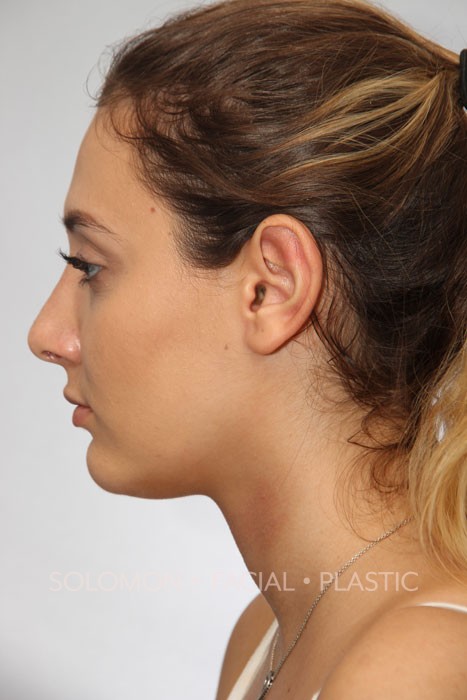 Female patient after primary rhinoplasty