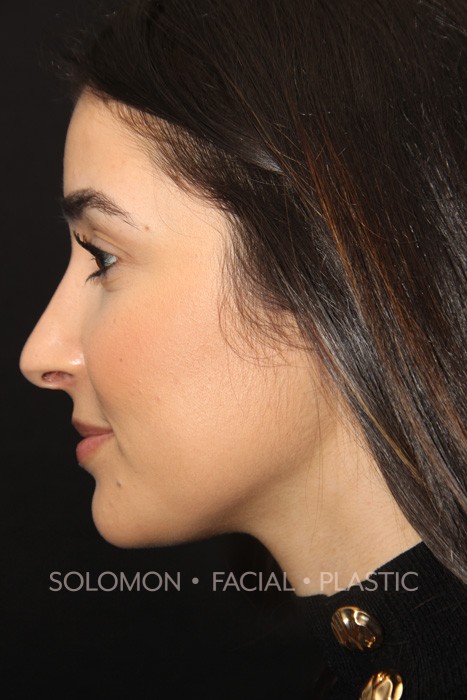 Female patient after primary rhinoplasty