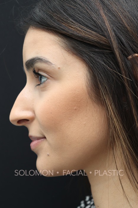 Female patient before primary rhinoplasty