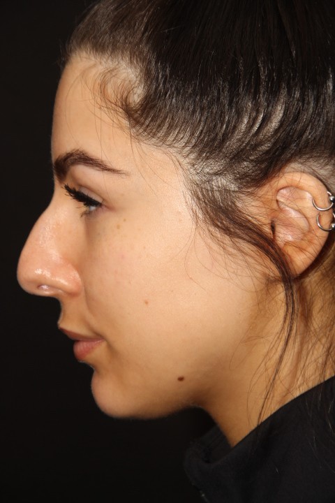 Female patient before primary rhinoplasty