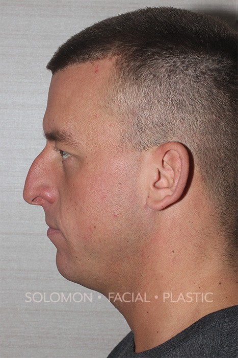 Male patient before primary rhinoplasty