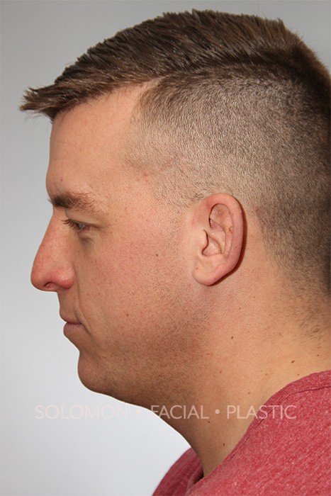 Male patient after primary rhinoplasty