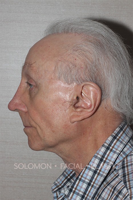 Male patient after rhinoplasty reconstruction