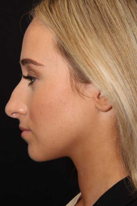 Female patient before primary rhinoplasty