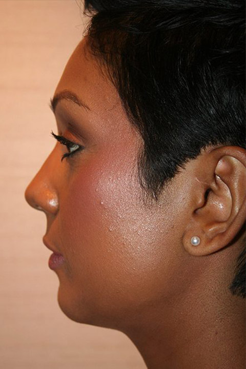 Female patient before Non Caucasian Rhinoplasty