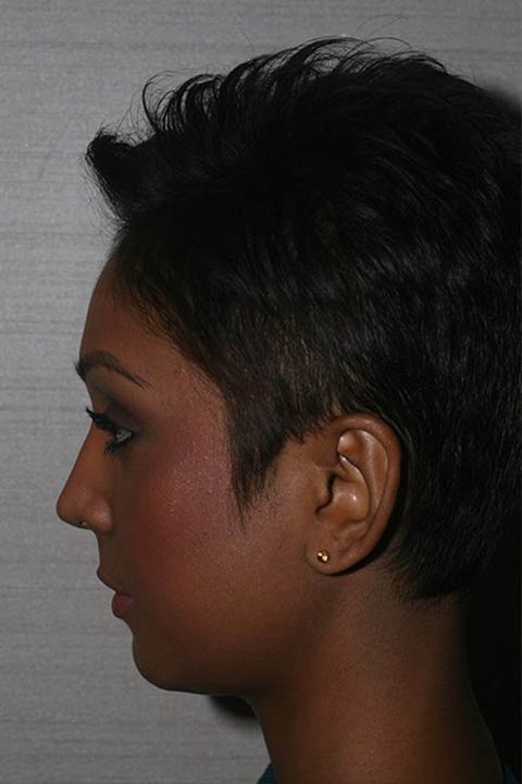 Female patient after Non Caucasian Rhinoplasty
