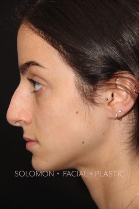 Female patient before primary rhinoplasty