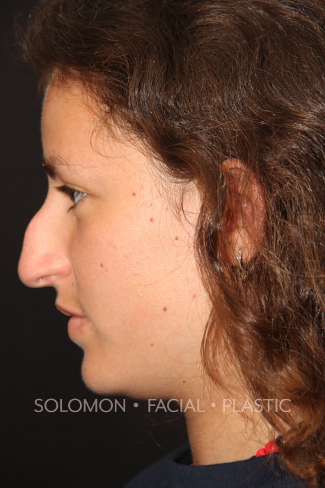 Female patient before primary rhinoplasty