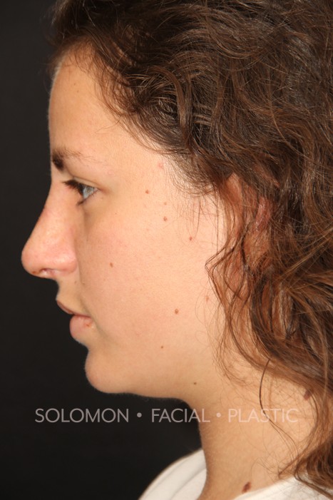 Female patient after primary rhinoplasty