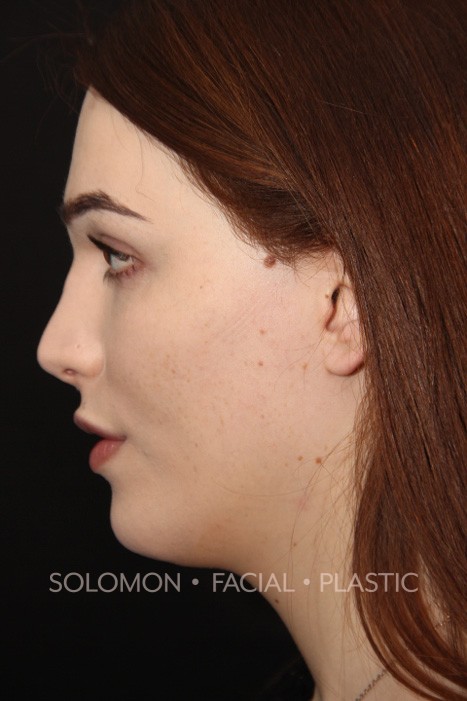Transgender patient after Transgender Rhinoplasty