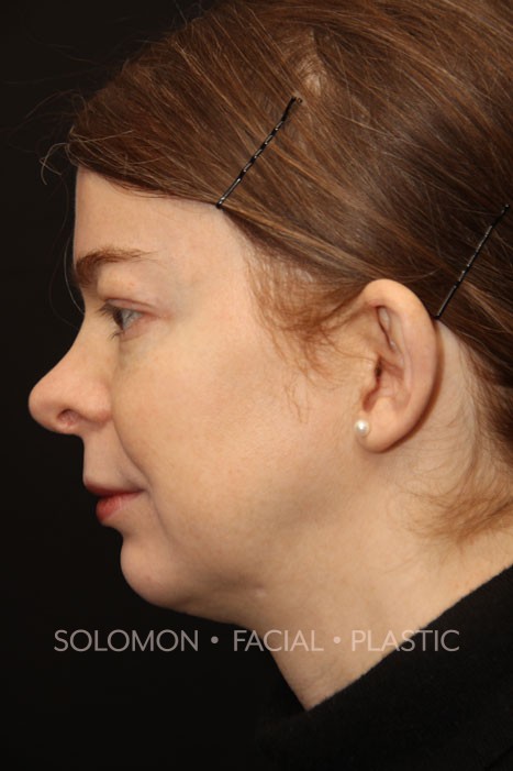 Transgender patient before Transgender Rhinoplasty