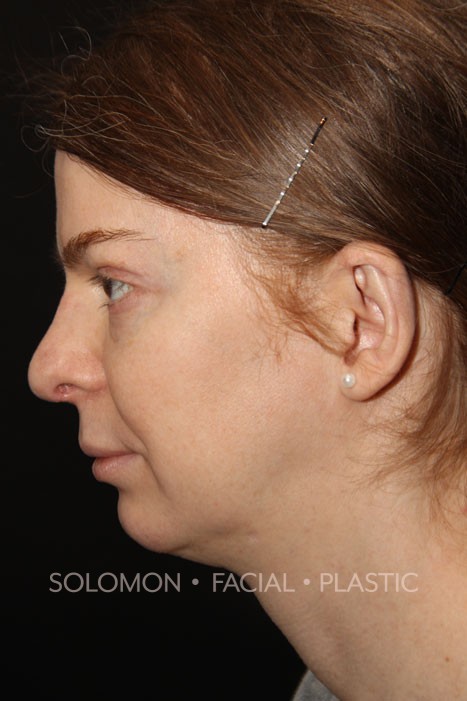 Transgender patient after Transgender Rhinoplasty