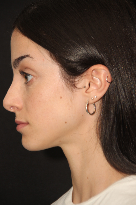 Female patient after primary rhinoplasty