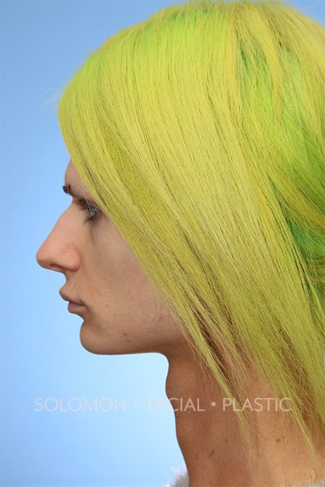 Transgender patient before Transgender Rhinoplasty