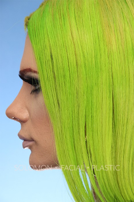 Transgender patient after Transgender Rhinoplasty